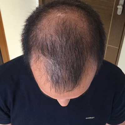 Liam — before